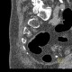 Flat lesion, colorectal carcinoma, sigmoid colon, CTC, CT colonography: CT - Computed tomography